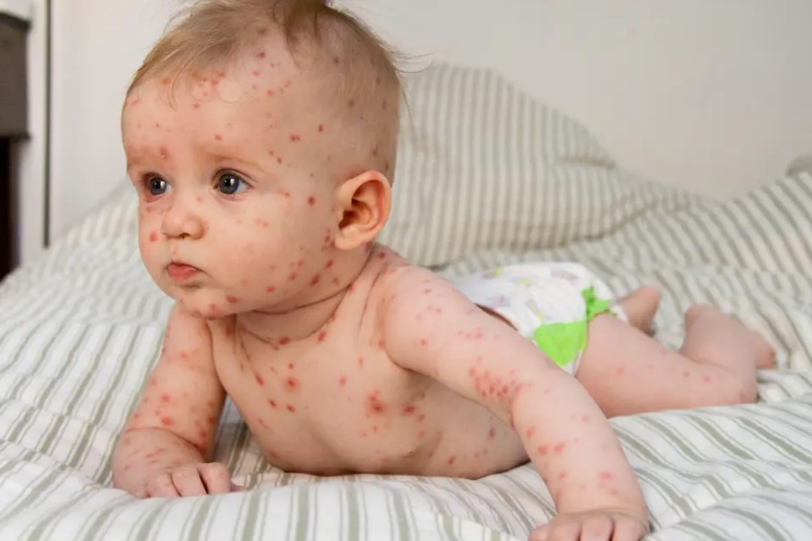 wysypka szkarlatyna u niemowląt